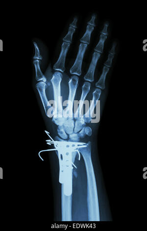 Röntgen Handgelenk AP Film: Fraktur distale Radius (Unterarm Knochen) zu zeigen. Es wurde operiert und eingefügt, Platte und K-wire(Kirschner wire Stockfoto