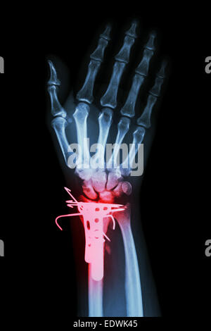 Röntgen Handgelenk AP Film: Fraktur distale Radius (Unterarm Knochen) zu zeigen. Es wurde operiert und eingefügt, Platte und K-wire(Kirschner wire Stockfoto