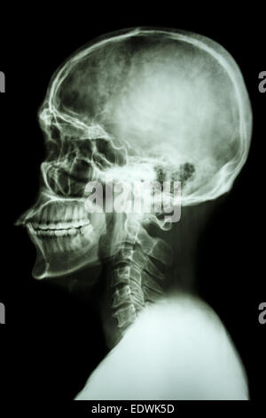 X-ray asiatischen Schädel und Halswirbelsäule Stockfoto