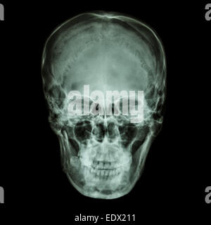 X-ray normal asiatischen Schädel (Thais) Stockfoto