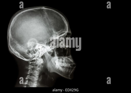 X-ray asiatischen Schädel (Thais) und leeren Bereich auf der rechten Seite Stockfoto