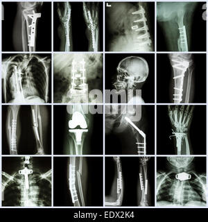 Kollektion Röntgen Orthopädie (mehrere Teile des Menschen, zu betreiben und Osteosynthese durch Platte & Schraube) Stockfoto