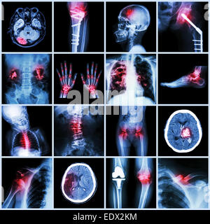 Eingestellt von x-ray mehrere Teil der menschlichen, mehrere Krankheiten, Orthopädie, Chirurgie (Schlaganfall, Knochenbrüchen, orthopädische Operation, Nierenstein, Stockfoto