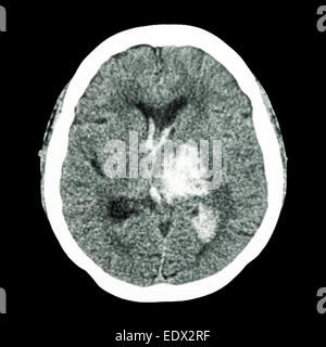 CT Gehirn: Show links Thalamische Blutung (hämorrhagischer Schlaganfall) Stockfoto