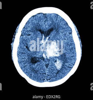 CT Gehirn: Show links Thalamische Blutung (hämorrhagischer Schlaganfall) Stockfoto