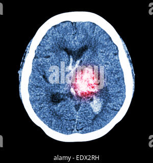 CT Gehirn: Show links Thalamische Blutung (hämorrhagischer Schlaganfall) Stockfoto