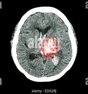 CT Gehirn: Show links Thalamische Blutung (hämorrhagischer Schlaganfall) Stockfoto