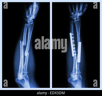 Fraktur beider Knochen des Unterarms. Es wurde operiert und interne mit Platte und Schraube fixiert (Bild links: vor der Inbetriebnahme, rechts Im Stockfoto