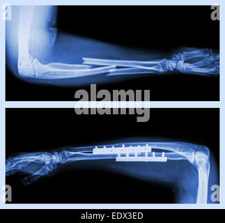 Bild oben: Fraktur ulnar und Radius (Unterarm-Knochen), unteres Bild: Es wurde operiert und interne mit Platte und Schrauben fixiert Stockfoto