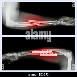 Bild oben: Fraktur ulnar und Radius (Unterarm-Knochen), unteres Bild: Es wurde operiert und interne mit Platte und Schrauben fixiert Stockfoto