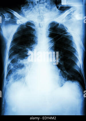 "Lungenentzündung mit respiratorischer Insuffizienz" Film Röntgen-Thorax des Patienten mit Endotrachealtubus, Katheter. Er wurde auf der Intensivstation behandelt. Stockfoto