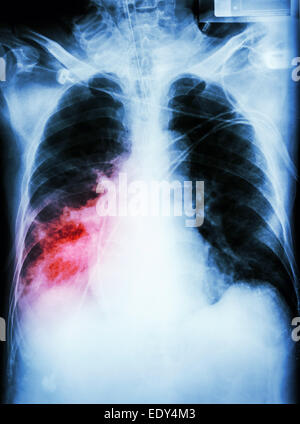 "Lungenentzündung mit respiratorischer Insuffizienz" Film Röntgen-Thorax des Patienten mit Endotrachealtubus, Katheter. Er wurde auf der Intensivstation behandelt. Stockfoto