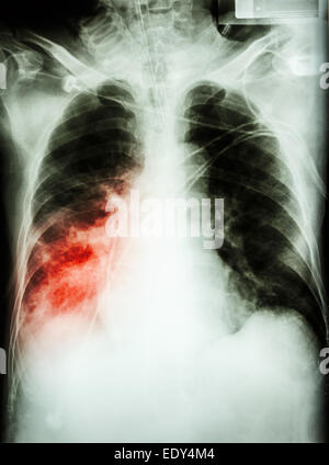 "Lungenentzündung mit respiratorischer Insuffizienz" Film Röntgen-Thorax des Patienten mit Endotrachealtubus, Katheter. Er wurde auf der Intensivstation behandelt. Stockfoto