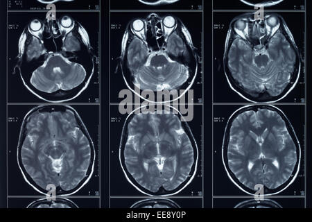 X-ray Kopf und Gehirn Radiographie Stockfoto