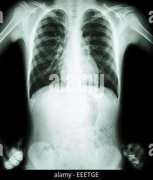 X-ray Brust (angewinkelten Position) (Frontansicht) Stockfoto