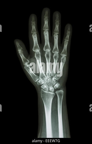 X-ray Hand & Unterarm AP (anterior-Posterior) (Vorderansicht) Stockfoto