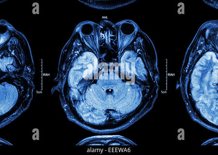Nahaufnahme von MRI Gehirn: unterer Teil des Gehirns (Augen, Temporallappen Großhirn, Kleinhirn, Hirnstamm) Stockfoto