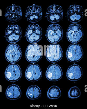 MRI Gehirn: Brain Tumor im rechten Scheitellappen Stockfoto