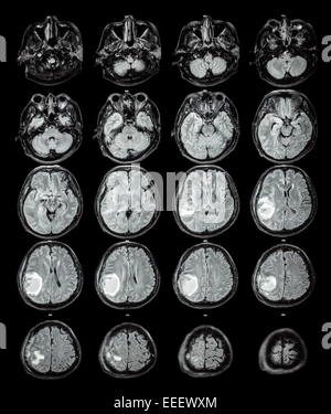 MRI Gehirn: Brain Tumor im rechten Scheitellappen Stockfoto