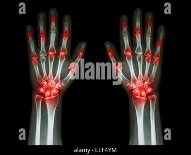 mehrere gemeinsame Arthritis Hände (Gicht, rheumatoide) auf schwarzem Hintergrund Stockfoto