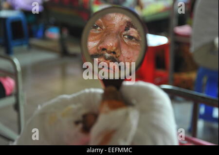 Dhaka, Bangladesch. 17. Januar 2015. Amulla Barmon beobachtete sein Gesicht in den Spiegel in Dhaka medizinische Klinik. Er verbrannte in einem Bus 11 Januar am Farmget in Dhaka. 35 Prozent seines Körpers wird verbrannt. Mindestens 12 Opfer wurden in den letzten 14 Tagen von politischer Gewalt zu brennen Einheit von Dhaka medizinische Klinik zugelassen. Sie wurden angegriffen und verbrannt in heftige politische Proteste. Bildnachweis: Mamunur Rashid/Alamy Live-Nachrichten Stockfoto