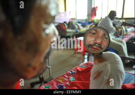 Dhaka, Bangladesch. 17. Januar 2015. Amulla Barmon beobachtete sein Gesicht in den Spiegel in Dhaka medizinische Klinik. Er verbrannte in einem Bus 11 Januar am Farmget in Dhaka. 35 Prozent seines Körpers wird verbrannt. Mindestens 12 Opfer wurden in den letzten 14 Tagen von politischer Gewalt zu brennen Einheit von Dhaka medizinische Klinik zugelassen. Sie wurden angegriffen und verbrannt in heftige politische Proteste. Bildnachweis: Mamunur Rashid/Alamy Live-Nachrichten Stockfoto