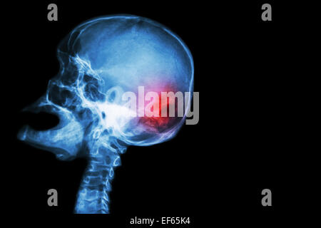 Röntgen Schädel offenem Mund (Seitenansicht) und Schlaganfall (Apoplexie (CVA)) und leeren Bereich auf der rechten Seite Stockfoto