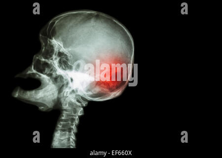 Röntgen Schädel offenem Mund (Seitenansicht) und Schlaganfall (Apoplexie (CVA)) und leeren Bereich auf der rechten Seite Stockfoto