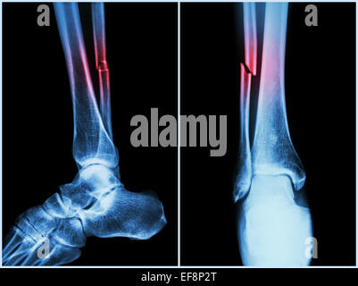 Fraktur-Schaft des Wadenbein (Fibula) Knochen (Knochen). Röntgen des ...