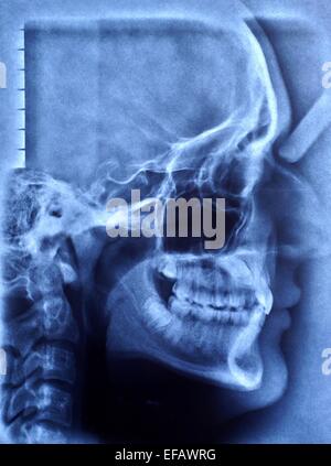 Röntgenbild der menschlichen Schädel Stockfoto