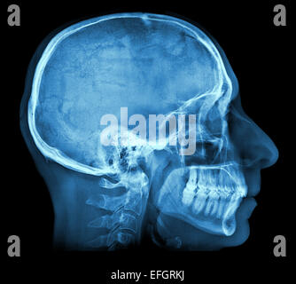 Menschlicher Schädel Röntgenbild isoliert auf schwarz Stockfoto