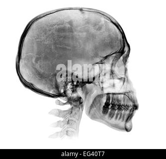 Menschlicher Schädel Röntgenbild isoliert auf weiss Stockfoto