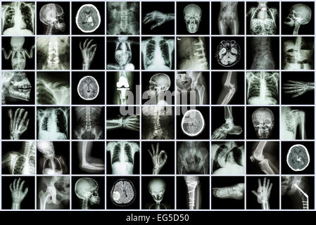 X-ray mehrere Teile von Erwachsenen und Kindern und Krankheit (Lungentuberkulose Schlaganfall Nierenstein Arthrose Knochen Fraktur Bogen Stockfoto