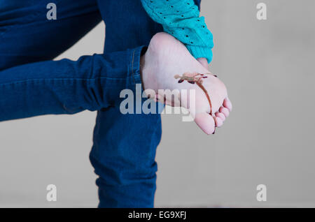 junges Mädchen blutend auf der Sohle des Fußes Stockfoto