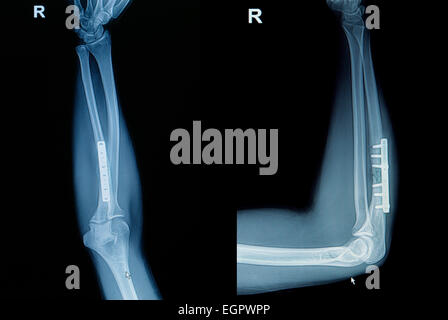 Film Röntgen Handgelenk Bruch: Fraktur Radius Knochen (Unterarm Knochen) mit eingefügten Platte und Schraube zeigen Stockfoto