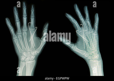 Roentgenfilm Hand Fraktur: Show Fraktur Mittelhandknochen Einsatz mit k-Draht (Kirschner-Draht) Stockfoto