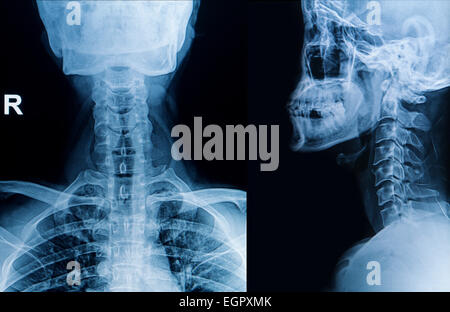 Röntgenbild der Halswirbelsäule, Nacken-Röntgenbild Stockfoto