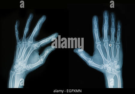 X-ray Hand und finger Stockfoto