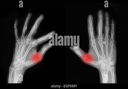 X-ray Hand und finger Stockfoto