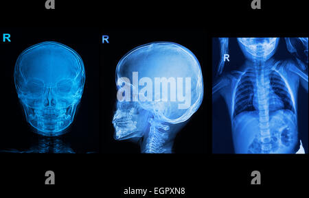 Auflistung von untergeordneten Elementen Röntgen Schädel und Brust Bild der Bild anzeigen Stockfoto
