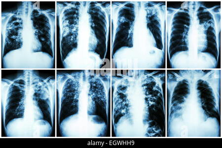 Lungentuberkulose-Sammlung.  Röntgen-Thorax: zeigen Sie lückenhaft Infiltration, interstitielle Infiltration, alveoläre infiltration Stockfoto