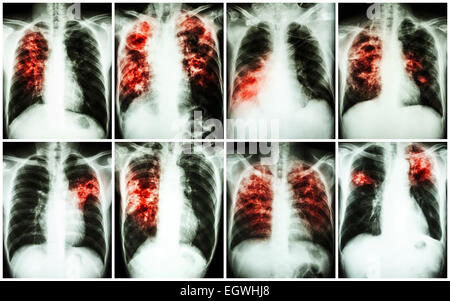 Lungentuberkulose-Sammlung.  Röntgen-Thorax: zeigen Sie lückenhaft Infiltration, interstitielle Infiltration, alveoläre infiltration Stockfoto