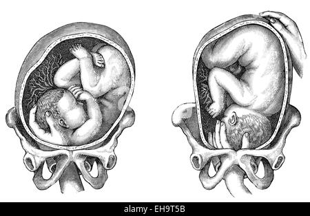 Geburt, die unterschiedlichen Positionen des Kindes bei der Geburt, Ratgeber Gesundheit, 19. Jahrhundert, Stockfoto