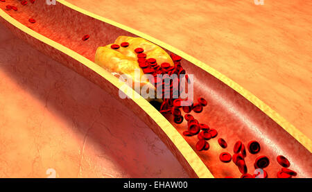 Verstopfte Arterie mit Thrombozyten und Cholesterin plaque Stockfoto