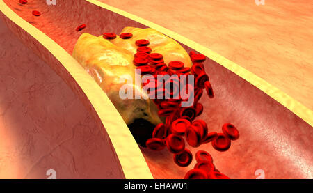 Verstopfte Arterie mit Thrombozyten und Cholesterin plaque Stockfoto