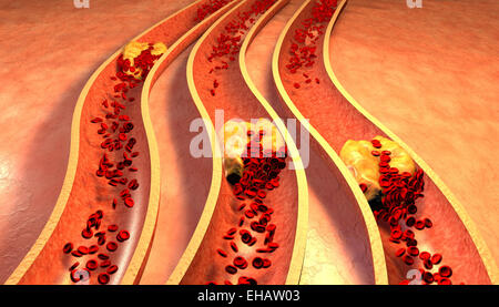 Verstopfte Arterie mit Thrombozyten und Cholesterin plaque Stockfoto