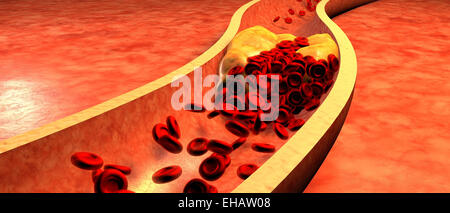 Verstopfte Arterie mit Thrombozyten und Cholesterin plaque Stockfoto