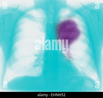 Farbige Röntgenaufnahme eines Patienten mit Lungenkrebs. Stockfoto
