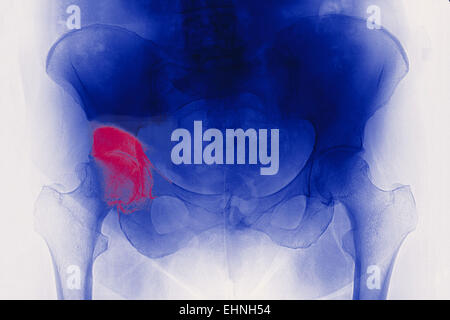 X-ray zeigt der Hüfte Arthritis. Arthritis ist eine Gelenkerkrankung, die kann dazu führen, dass Knorpel Zerstörung (gesehen als eine Verringerung der Gelenkspalt, rosa), Knochen, Erosionen und Sehnenentzündung. Stockfoto