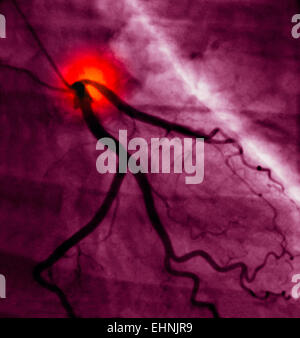Koronaren Angiogramm stenosierter Arterie. Stockfoto